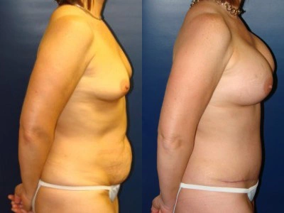 abdominoplasty-saline-breast-implants-9-2