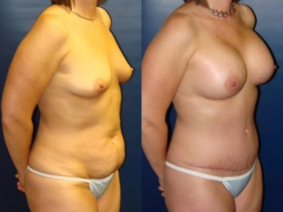 abdominoplasty-saline-breast-implants-9-3