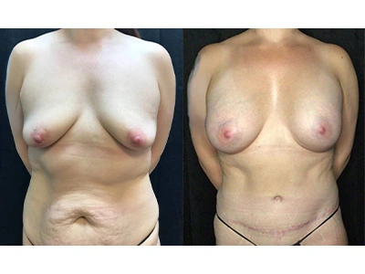 abdominoplasty-silicone-breast-augmentation 10-1