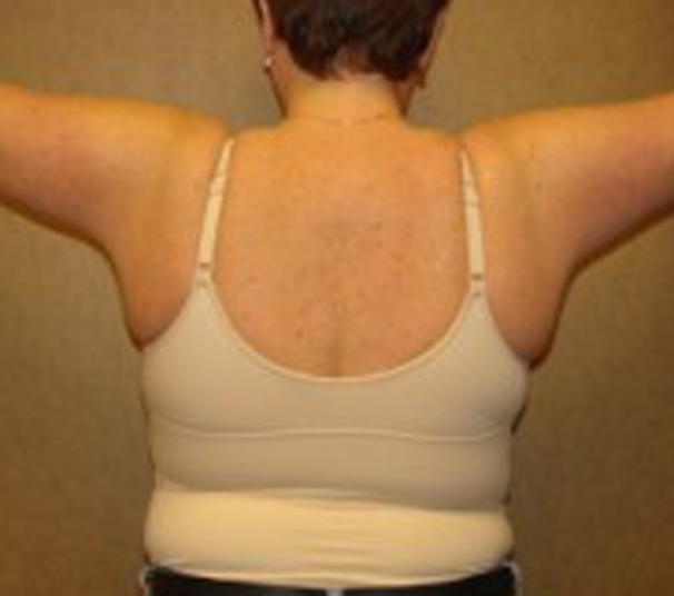 armlift-pro-03