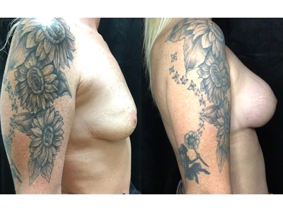 Before and after breast augmentation, patient case 20003, view 3