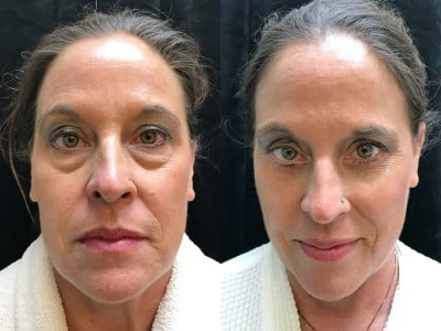 blepharoplasty-lower-lids 1-1