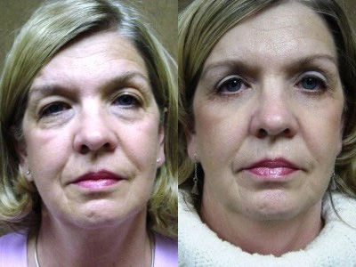 blepharoplasty-upper-and-lower-eyelids 2-1
