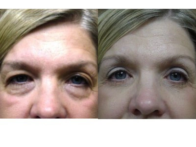 blepharoplasty-upper-and-lower-eyelids 2-2