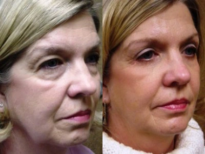 blepharoplasty-upper-and-lower-eyelids 2-3