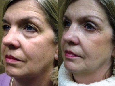 blepharoplasty-upper-and-lower-eyelids 2-4
