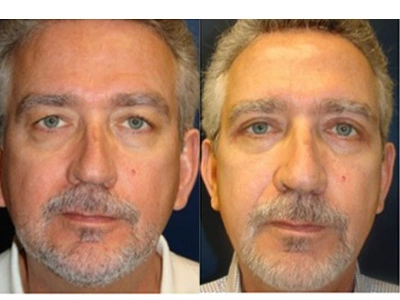 blepharoplasty-upper-lower 3-1