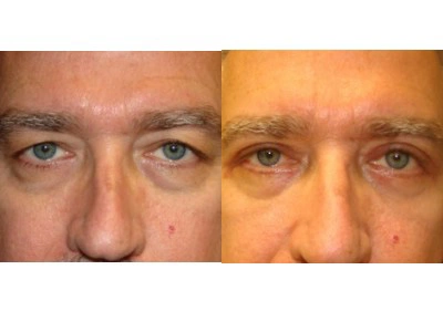 blepharoplasty-upper-lower 3-2