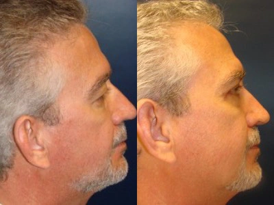 blepharoplasty-upper-lower 3-3
