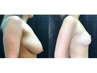 Before and after cosmetic breast reduction, patient case 20001, view 3