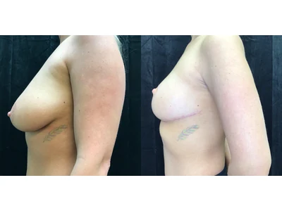 Before and after cosmetic breast reduction, patient case 20001, view 5