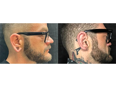 earlobe-repair 6-1