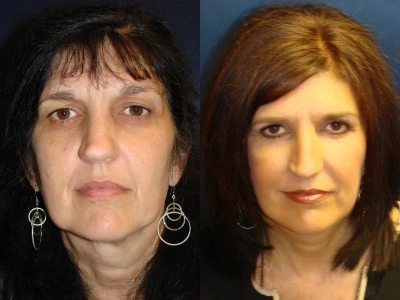 face-lift-blepharoplasty-upper-and-lower-eyelids 4-1
