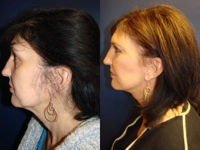 face-lift-blepharoplasty-upper-and-lower-eyelids 4-2
