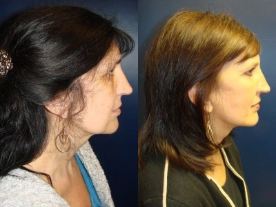 face-lift-blepharoplasty-upper-and-lower-eyelids 4-3