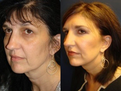face-lift-blepharoplasty-upper-and-lower-eyelids 4-4