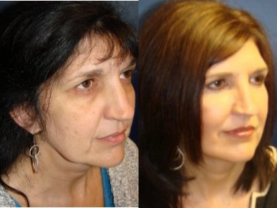 face-lift-blepharoplasty-upper-and-lower-eyelids 4-5