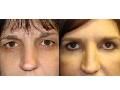 face-lift-blepharoplasty-upper-and-lower-eyelids 4-6