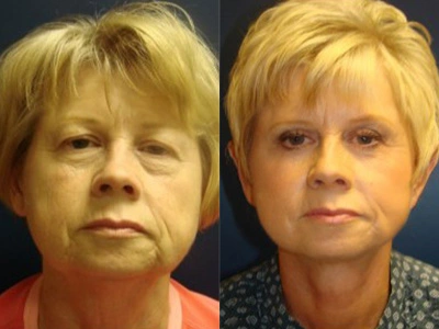 face-lift-blepharoplasty-upper-and-lower-eyelids 5-1