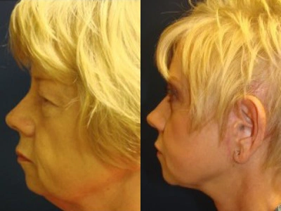 face-lift-blepharoplasty-upper-and-lower-eyelids 5-2