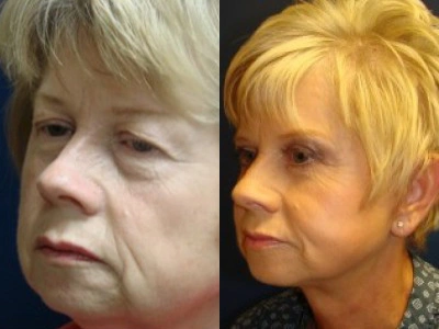 face-lift-blepharoplasty-upper-and-lower-eyelids 5-3