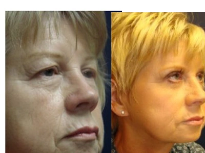 face-lift-blepharoplasty-upper-and-lower-eyelids 5-4