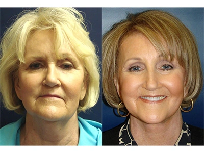 facelift 12-1