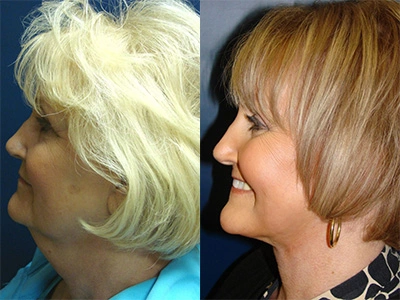 facelift 12-2