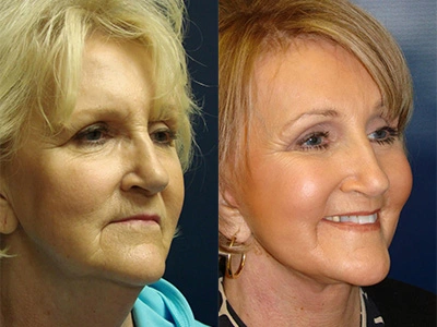 facelift 12-3