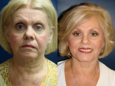 facelift 13-1