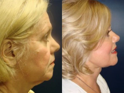 facelift 13-2