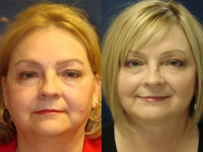 facelift 14-1