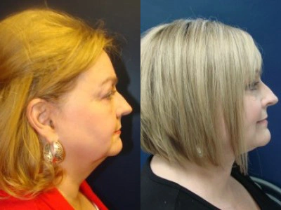 facelift 14-2