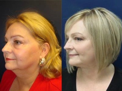 facelift 14-4