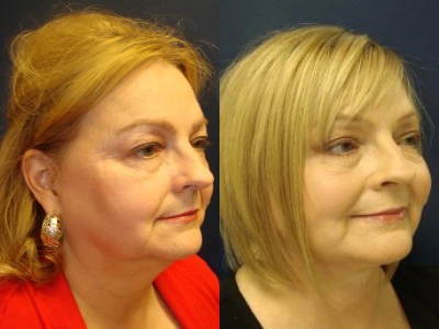 facelift 14-5
