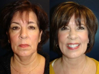 facelift 15-1