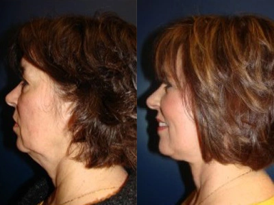 facelift 15-2