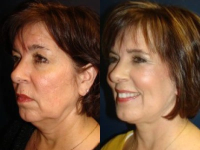 facelift 15-4