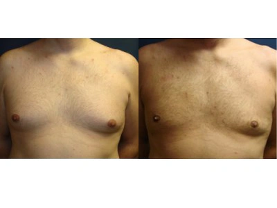 gynecomastia 1-1