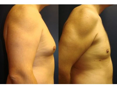 gynecomastia 1-2