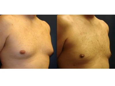 gynecomastia 1-3