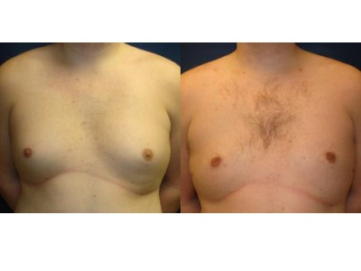 gynecomastia 2-1