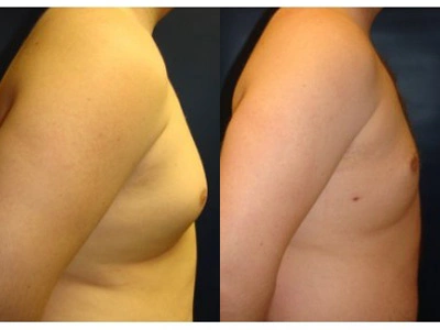 gynecomastia 2-2