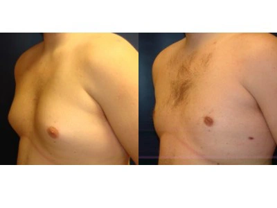 gynecomastia 2-3