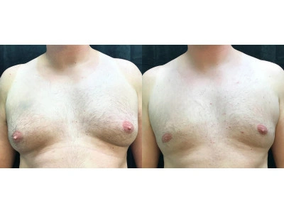 gynecomastia 3-1