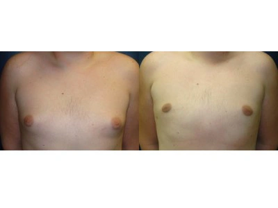 gynecomastia 4-1