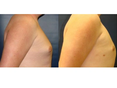 gynecomastia 4-2