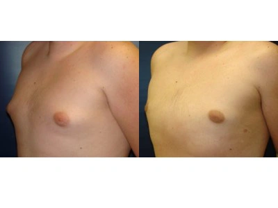 gynecomastia 4-3