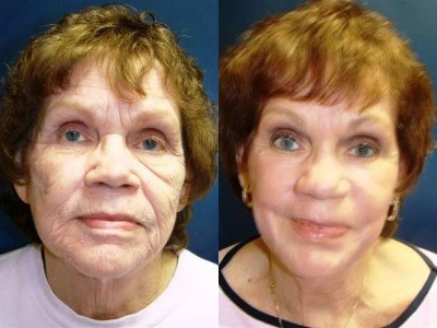 laser-resurfacing 11-1