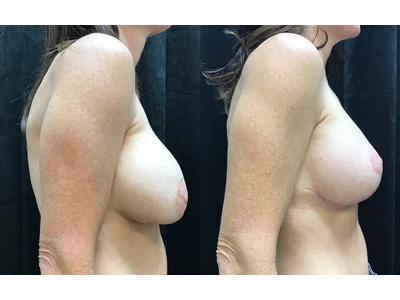 Before and after breast lift, patient case 20002, view 3